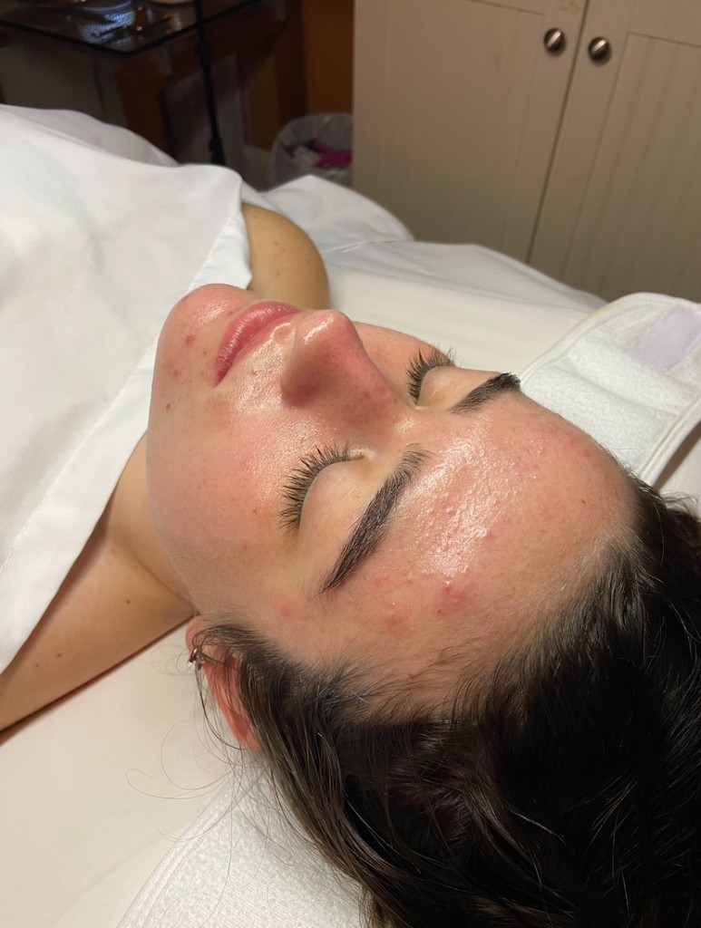 Skin after Acne Clarification treatment, clearer, calmer complexion