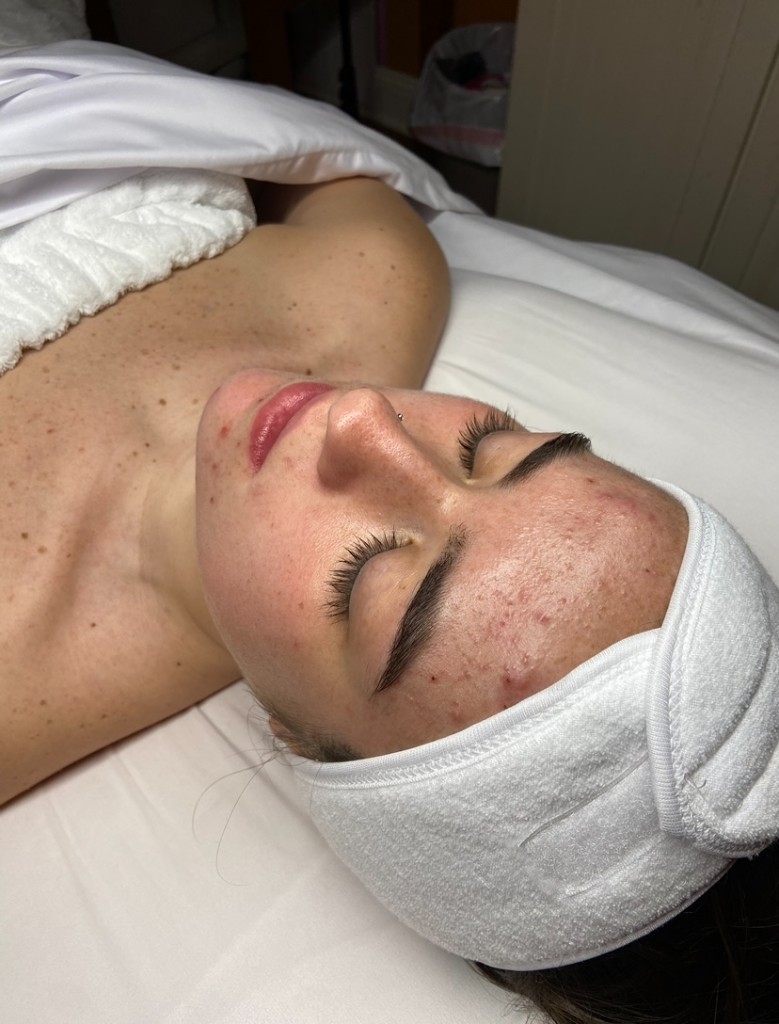 Skin before Acne Clarification treatment