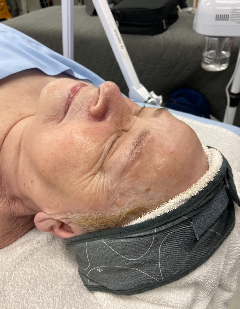 Skin after Anti-Aging facial treatment, firmer, smoother appearance