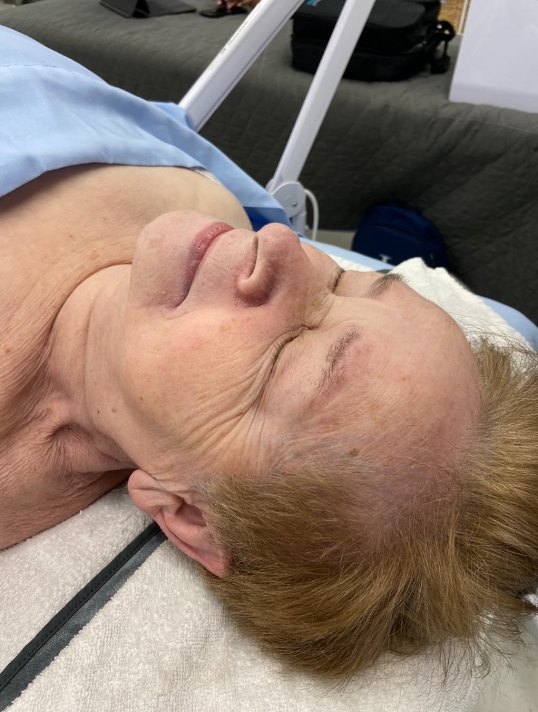 Skin before Anti-Aging facial treatment