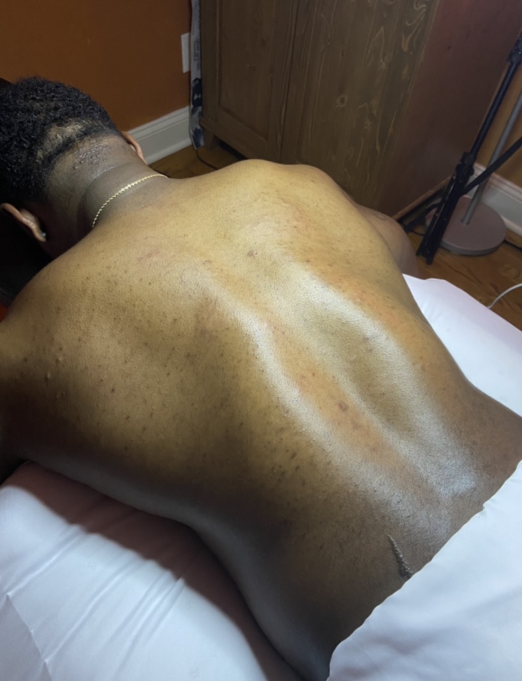 Back skin after Clarifying Back Treatment, clearer, more even tone