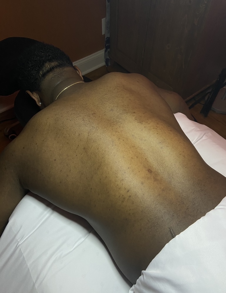 Back skin before Clarifying Back Treatment