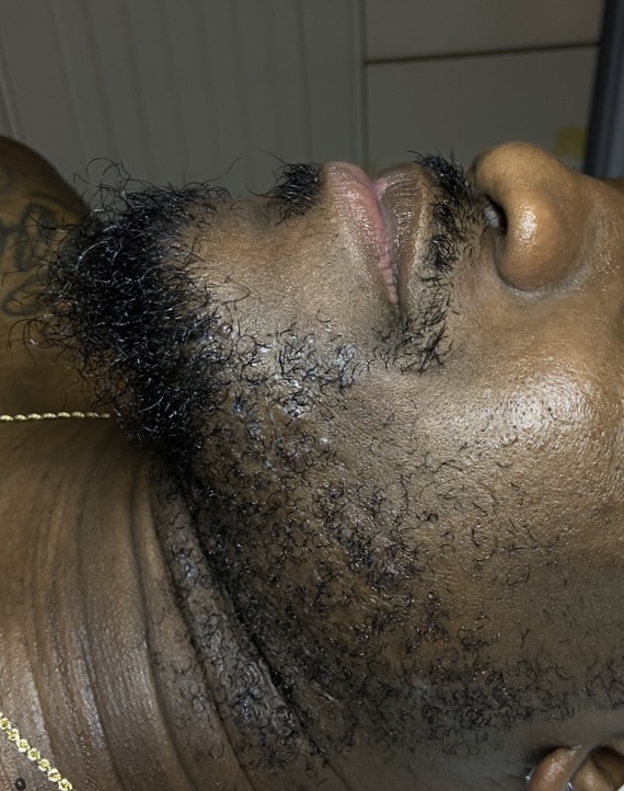 Skin after Gentlemen's facial treatment, calmer, smoother beard area