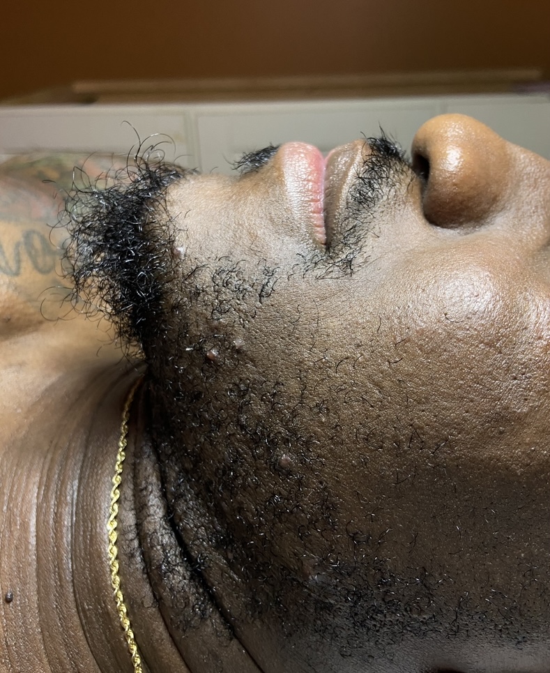 Skin before Gentlemen's facial treatment