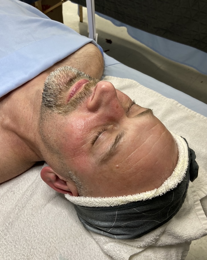 Skin after Microdermabrasion treatment, smoother, more refined texture