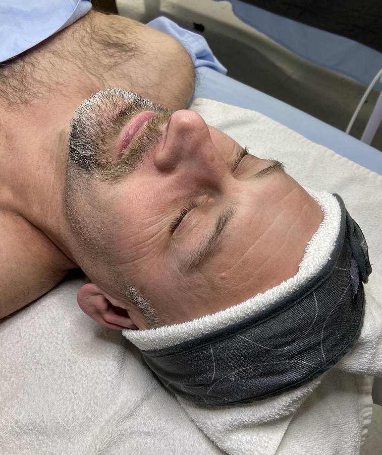 Skin before Microdermabrasion treatment